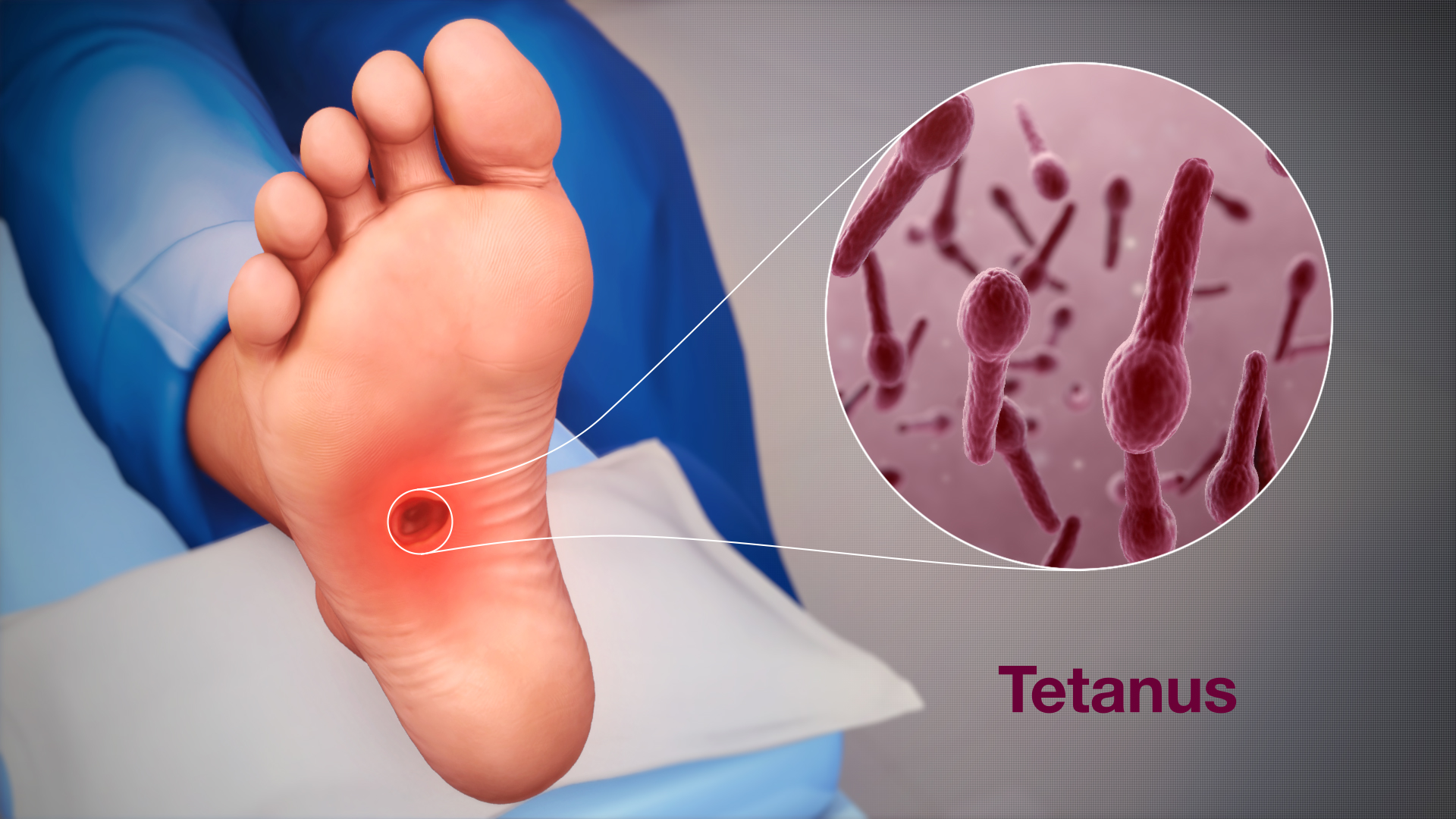 Тетанус: симптоми, причини и лечение