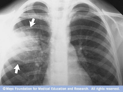 Рентгеново изображение на белите дробове с пневмония