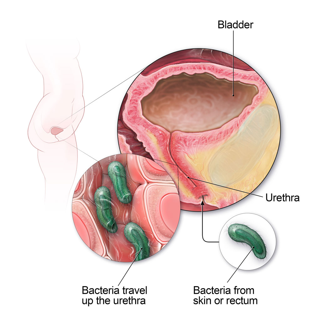 При жените бактериите от кожата или ректума могат да пътуват нагоре по уретрата и да причинят инфекция на пикочния мехур.